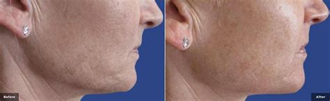 Secret RF | Rejuvenate, Repair, Skin Naturally | For All Skin Types