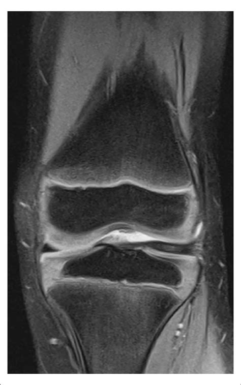 T2-weighted MRI demonstrating lateral discoid meniscus in coronal... | Download Scientific Diagram