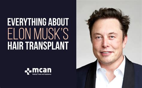 Everything About Elon Musk Hair Transplant