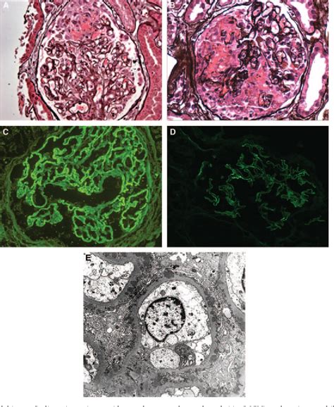 Figure 1 from Membranous glomerulonephritis with ANCA-associated necrotizing and crescentic ...