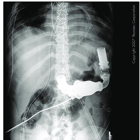 Perioperative approach to LVAD patients undergoing non-cardiac surgery ...