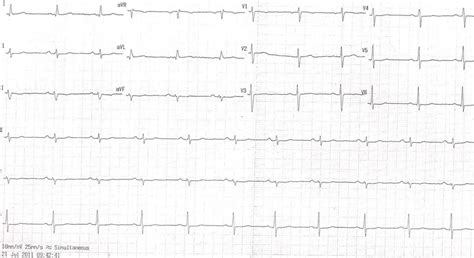 flat t wave | Dr.S.Venkatesan MD