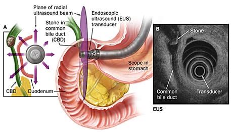 Endoscopic Ultrasconography Rectum/Colon (EUS)