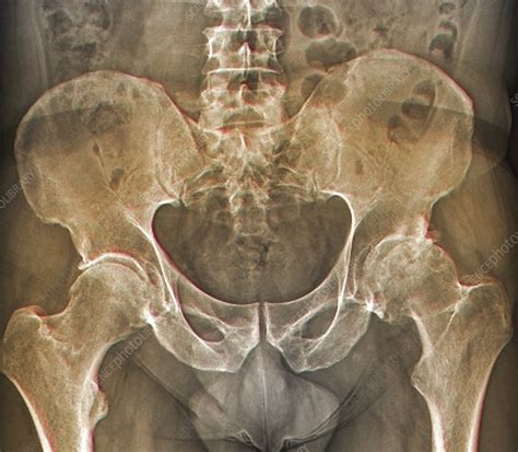 Osteoarthritis of the hip, X-ray - Stock Image - F006/3745 - Science ...