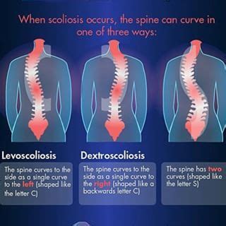 Pin by Lizzy Rose on thoracic levoscoliosis-curved upper back which I ...