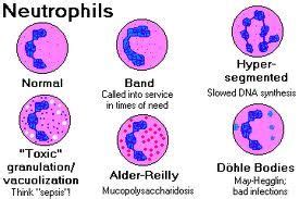 Hypersegmented Neutrophil- What is it, conditions in which it is found |The Health and Disease ...