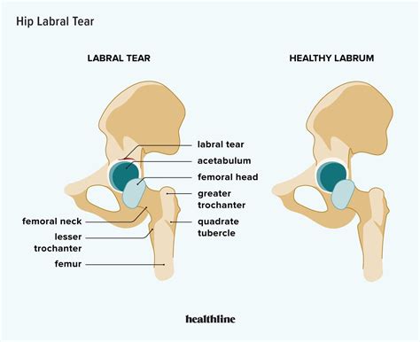 Hip Labral Tear: Causes, Symptoms, Treatment and More