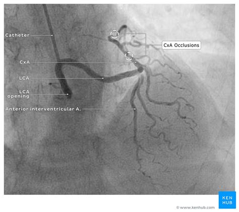 Abnormal left coronal artery: Case and images | Kenhub