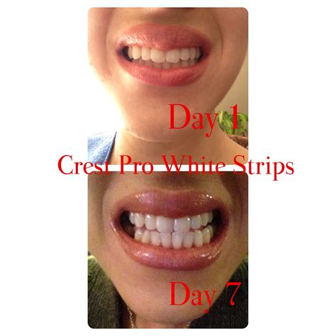 Crest 3d White Strips Before And After Pictures