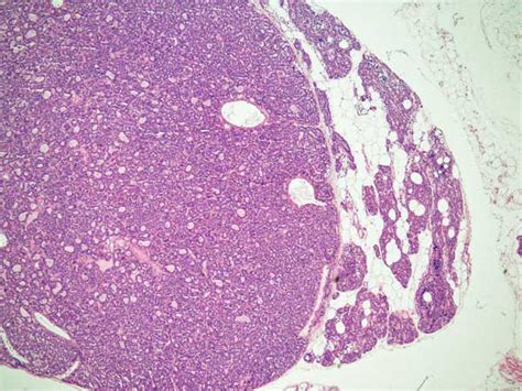 Primary HPT Causes - Endocrinesurgery.net.au