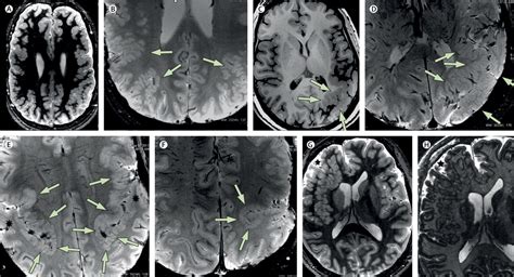 Malformations of cortical development: clinical features and genetic causes - The Lancet Neurology