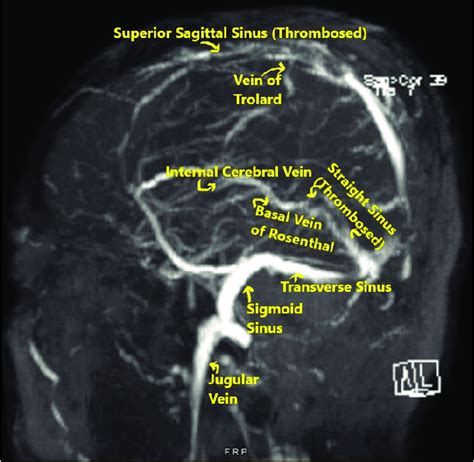 Cerebral venous anatomy on magnetic resonance venogram (MRV). | Download Scientific Diagram