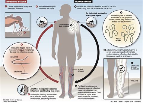 Lymphatic Filariasis - Nursing Clinics