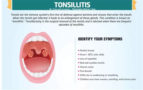 Treatment of Tonsillitis - Philadelphia Holistic Clinic - Dr. Tsan & Associates