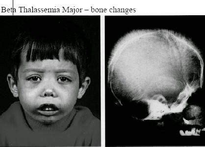 chipmunk facies thalassemia