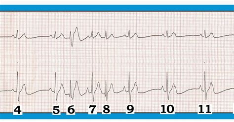 ECG Interpretation: ECG Interpretation Review #78 (PACs – Atrial Bigeminy – Aberrancy – Blocked ...