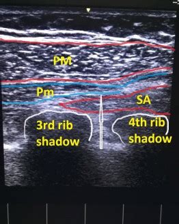 Pecs2block