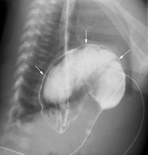 Neonatal acute gastric volvulus | ADC Fetal & Neonatal Edition