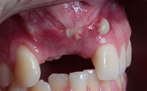 How to deal with Complications in Oral Implantology - DL Oral Surgery Academy