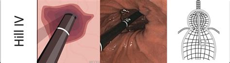 Hiatus hernias and the Hill classification - Endoscopy Campus