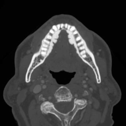 Mandibular tori | Radiology Reference Article | Radiopaedia.org