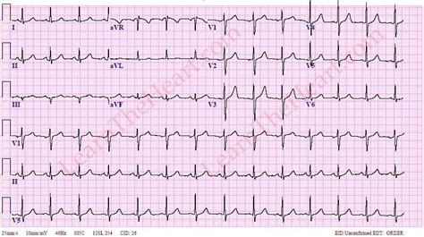 ECG Case #22 - Question #1 | LearntheHeart.com