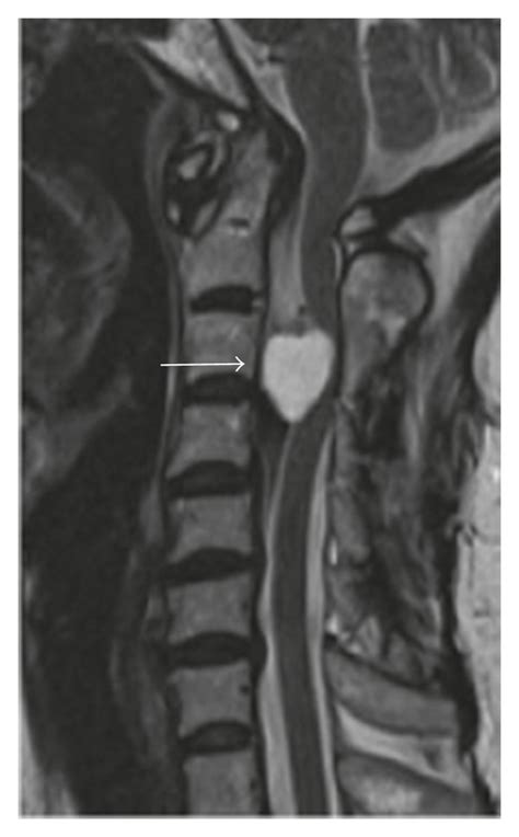 Magnetic resonance imaging (MRI) showing the intradural extramedullary... | Download Scientific ...