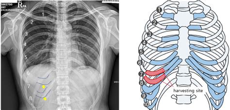 Surface Anatomy Of Ribs - 7 Surface Anatomy : Bony landmarks.—the second costal cartilage ...