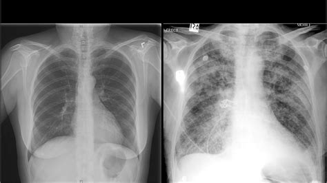 Chest X Ray Pneumonia Vs Chf at Melissa Eaton blog