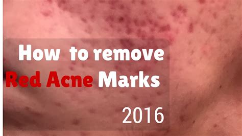 How to remove red marks from acne - YouTube