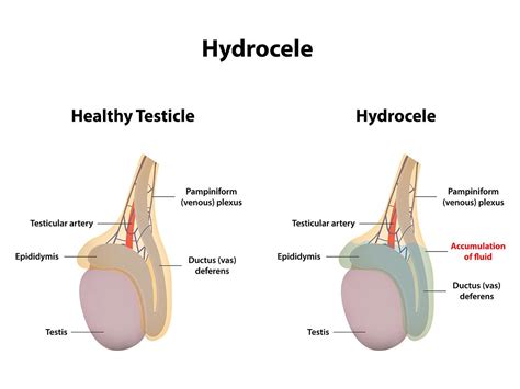 Hydrocele Laser Surgery - Treatment, Benefits & Complications