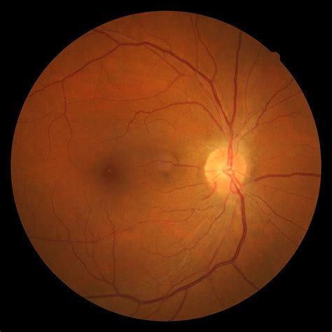 Hypertensive retinopathy - Wikipedia