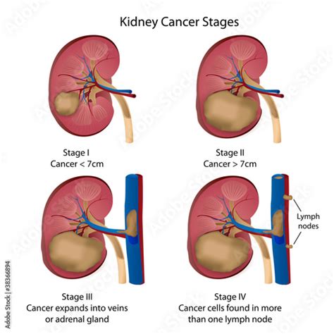 kidney cancer stages vector illustration Stock Vector | Adobe Stock