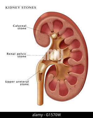 Illustration showing three types of kidney stones: Calyceal stone (top ...