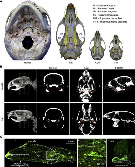 JCI Insight - Foramen lacerum impingement of trigeminal nerve root as a rodent model for ...