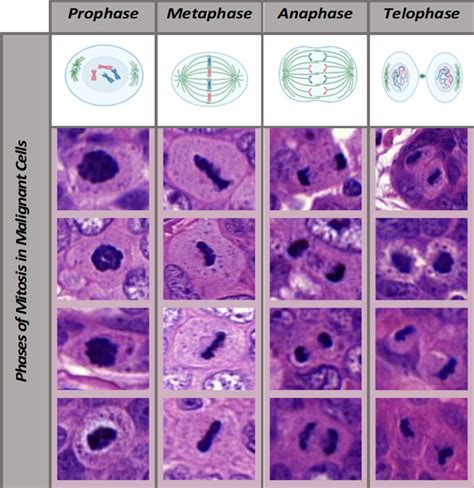 Assessment of mitotic activity in breast cancer: revisited in the digital pathology era ...