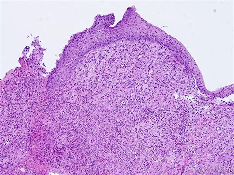 Oral Pyogenic Granuloma Histology