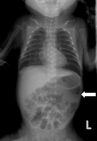 Neonatal gastric perforation enclosed by the lesser sac - Pediatrics & Neonatology