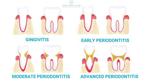 Stages of Periodontal Disease: How Gum Disease is Treated