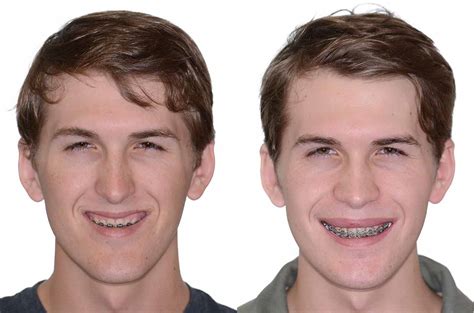 Double Jaw Orthognathic Surgery - Corrective Jaw Surgery - Dr. Antipov