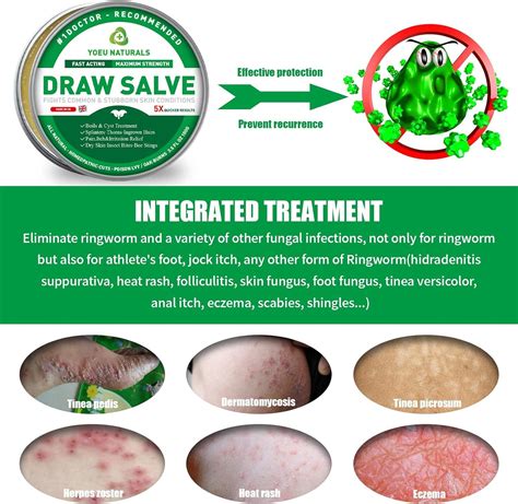 Drawing Salve Cream for Boil Cyst Removal Patch Splinter Remover Boil Ease Ingrown Hair Chigger ...