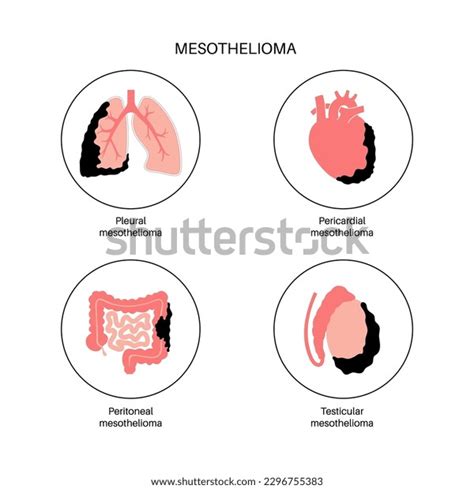 Types Mesothelioma Tumor Cancer Cells Spreading Stock Vector (Royalty ...