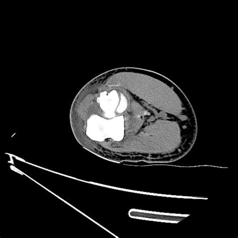 Left elbow CT scan - Upper Extremity CTs - embodi3D.com