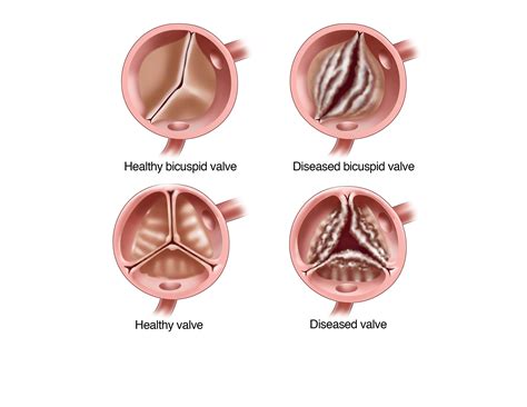 Aortic Valve Stenosis Symptoms and Replacement | UPMC