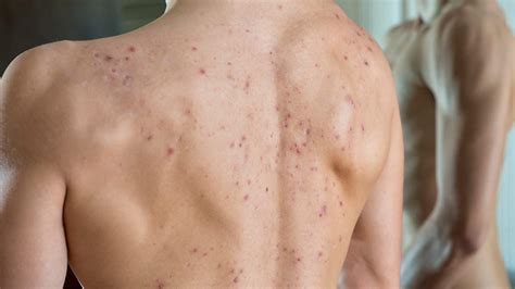 Cystic back acne: Causes and how to treat it