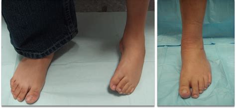 clubfoot surgery adult and pediatric ilizarov — Foot & Ankle Surgery