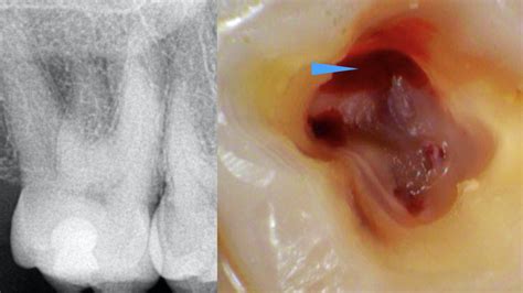 Dental News - Clinical management of maxillary second molar root canal therapy in different ...