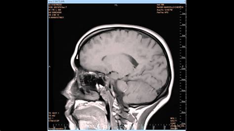 Brain MRI Side View - YouTube