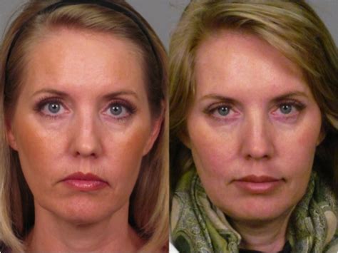 Botox Before After Photo Gallery Atlanta | Roswell GA