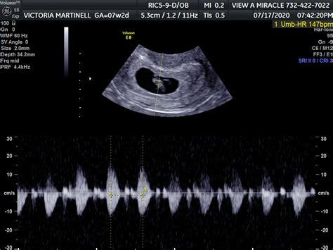 6 Week Ultrasound Heartbeat